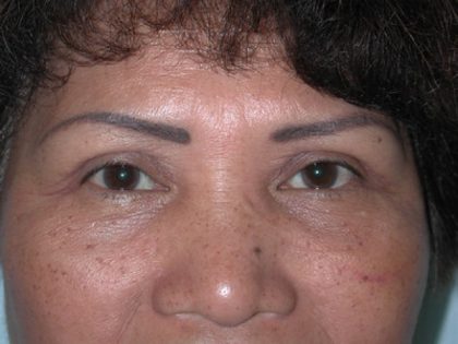 Blepharoplasty Before & After Patient #336