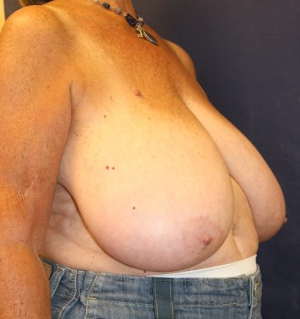 Breast Reduction Before & After Patient #297