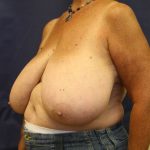 Breast Reduction Before & After Patient #297