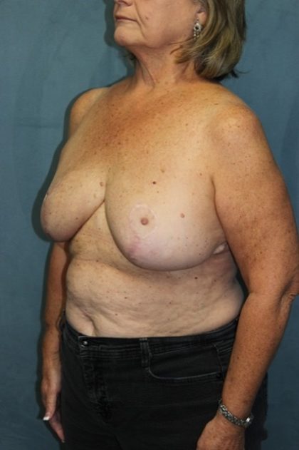Breast Reduction Before & After Patient #297