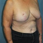 Breast Reduction Before & After Patient #297