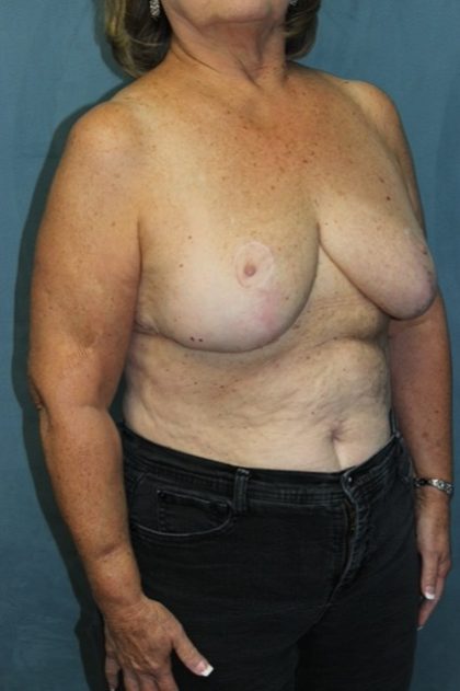 Breast Reduction Before & After Patient #297