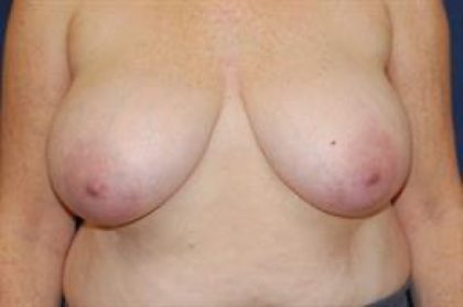 Breast Reduction Before & After Patient #284