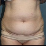 Tummy Tuck Before & After Patient #1825