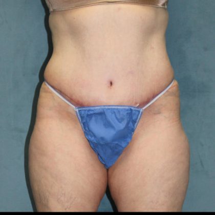 Tummy Tuck Before & After Patient #1825