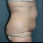 Tummy Tuck Before & After Patient #1825