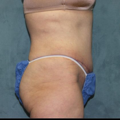 Tummy Tuck Before & After Patient #1825