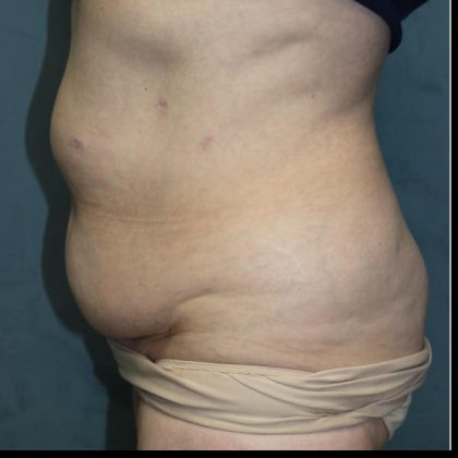 Tummy Tuck Before & After Patient #1825