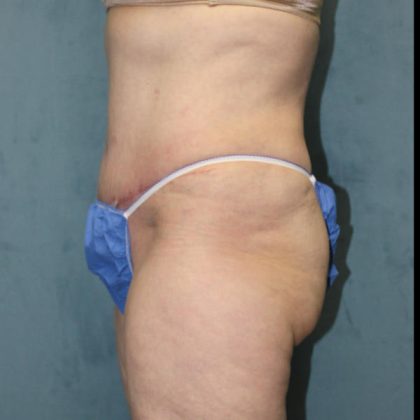 Tummy Tuck Before & After Patient #1825