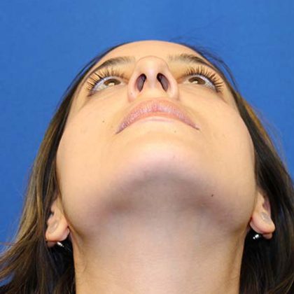 Rhinoplasty Before & After Patient #3573