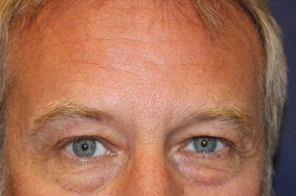 Blepharoplasty Before & After Patient #1770