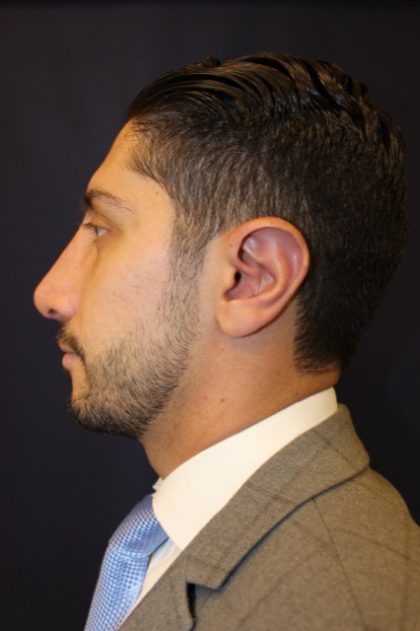 Rhinoplasty Before & After Patient #1904