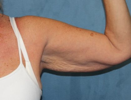 Arm Lift Before & After Patient #1932