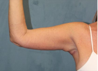Arm Lift Before & After Patient #1932