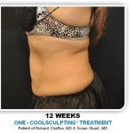 Coolsculpting Before & After Patient #2756