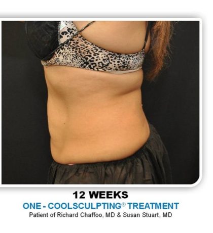 Coolsculpting Before & After Patient #2756
