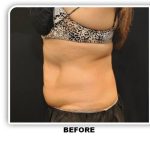 Coolsculpting Before & After Patient #2756