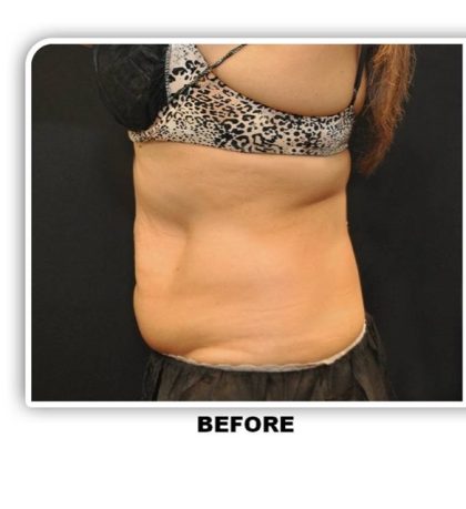 Coolsculpting Before & After Patient #2756