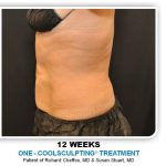 Coolsculpting Before & After Patient #2753