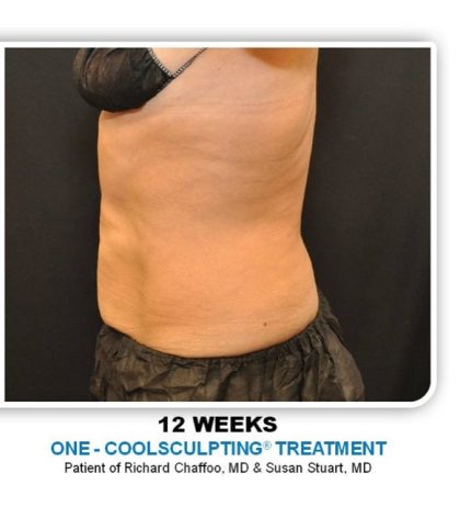 Coolsculpting Before & After Patient #2753