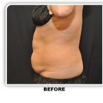 Coolsculpting Before & After Patient #2753