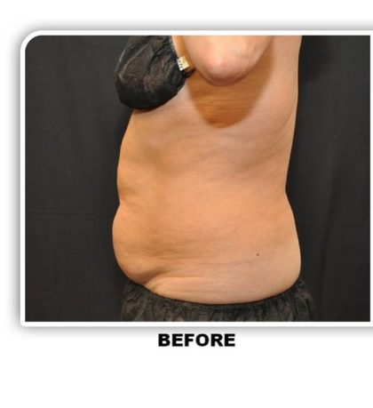 Coolsculpting Before & After Patient #2753