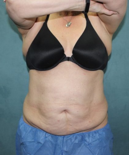 Coolsculpting Before & After Patient #2709