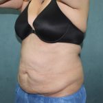 Coolsculpting Before & After Patient #2709