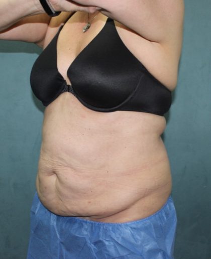 Coolsculpting Before & After Patient #2709