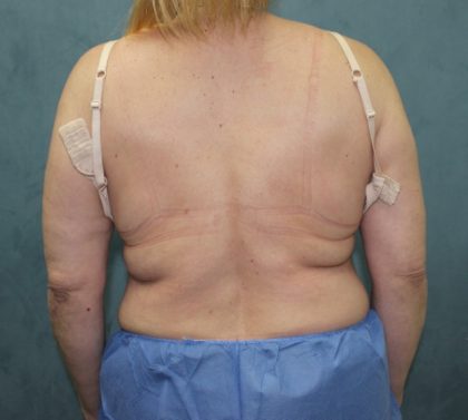 Coolsculpting Before & After Patient #2709