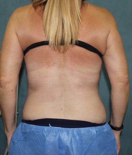 Coolsculpting Before & After Patient #2709