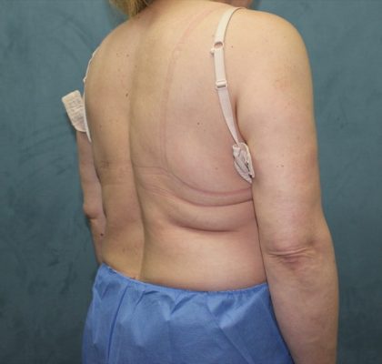 Coolsculpting Before & After Patient #2709