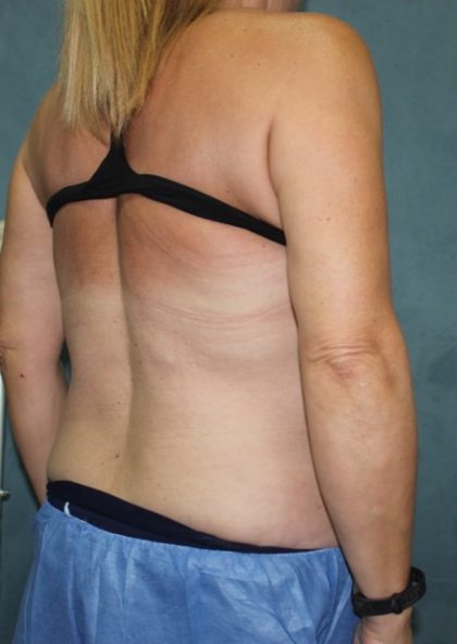 Coolsculpting Before & After Patient #2709