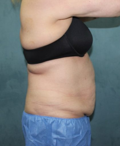 Coolsculpting Before & After Patient #2709