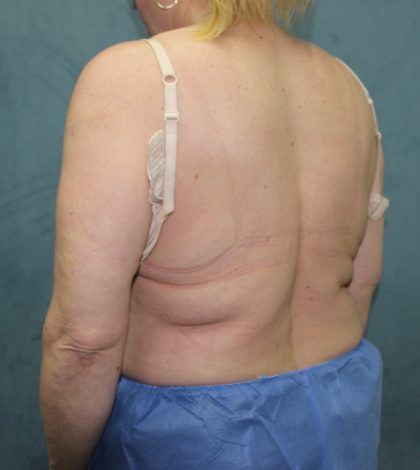 Coolsculpting Before & After Patient #2709