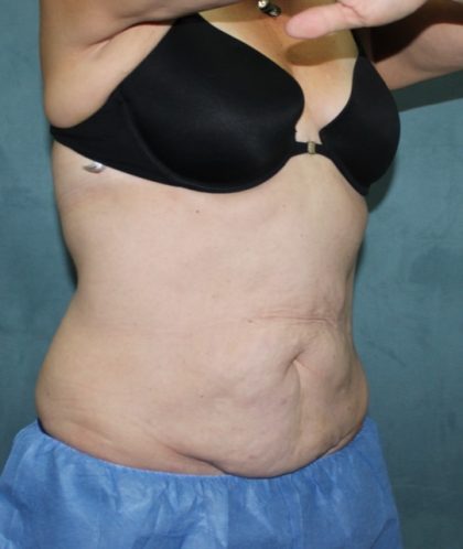 Coolsculpting Before & After Patient #2709