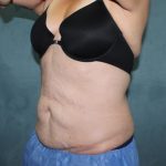 Coolsculpting Before & After Patient #2709