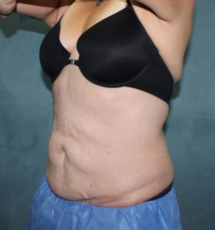 Coolsculpting Before & After Patient #2709