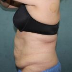 Coolsculpting Before & After Patient #2709