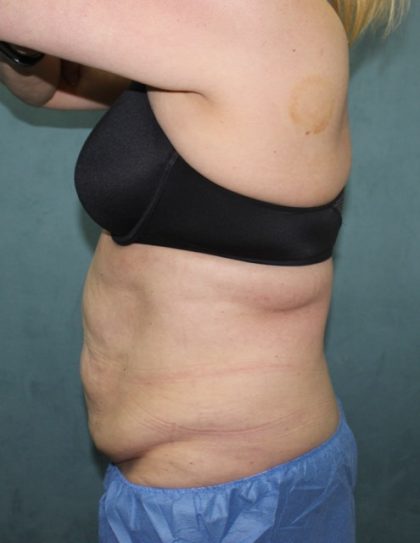 Coolsculpting Before & After Patient #2709