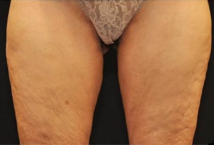 Coolsculpting Before & After Patient #2750