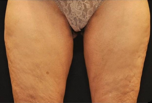Coolsculpting Before & After Patient #2750