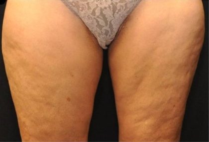 Coolsculpting Before & After Patient #2750