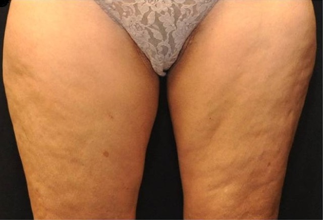 Coolsculpting Before & After Patient #2750