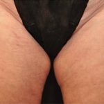 Coolsculpting Before & After Patient #2747