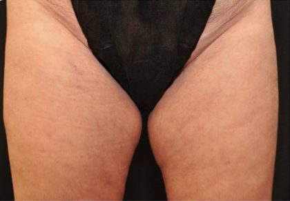 Coolsculpting Before & After Patient #2747