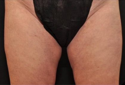 Coolsculpting Before & After Patient #2747