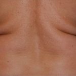 Coolsculpting Before & After Patient #2734