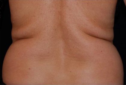 Coolsculpting Before & After Patient #2734