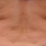 Coolsculpting Before & After Patient #2734
